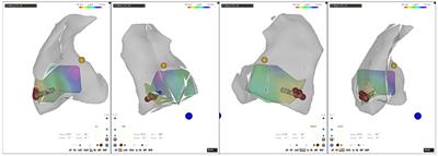 Electrocardiographic Characteristics and Catheter Ablation of Ventricular Arrhythmias Originating From the Moderator Band in Children